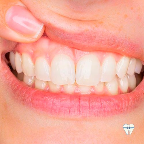 Periodontia - Gengivite - Tratamento da gengiva