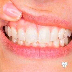 Periodontia / Tratamento da gengiva